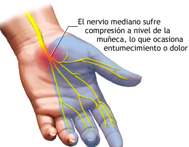 ¿Qué es síndrome del túnel carpiano , causas y tratamientos?