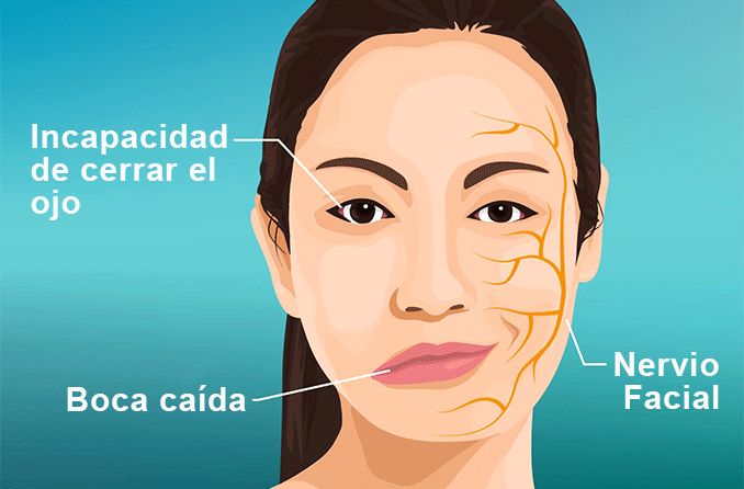 Fisioterapia para Parálisis Facial: Causas y síntomas Tratamiento con Láser de Alta Intensidad